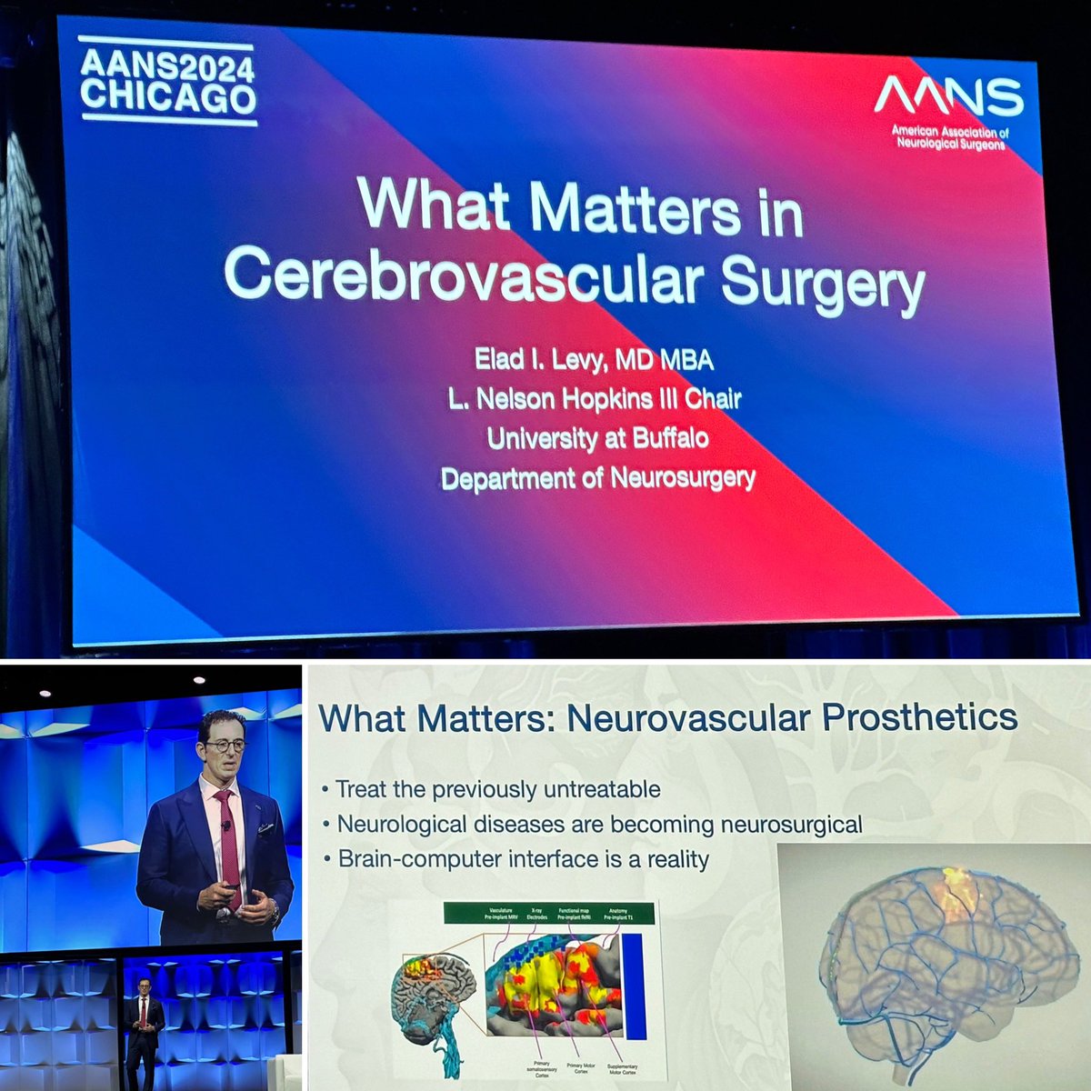 A great start to Plenary Session 3 with Dr. Levy @EladLevyMD on What Matters in Cerebrovascular Surgery! #AANS2024 @UB_Neurosurgery @IsaacYangMD @UCLANsgy @AANSNeuro #WhatMatters2Me #cerebrovascular #neurosurgery