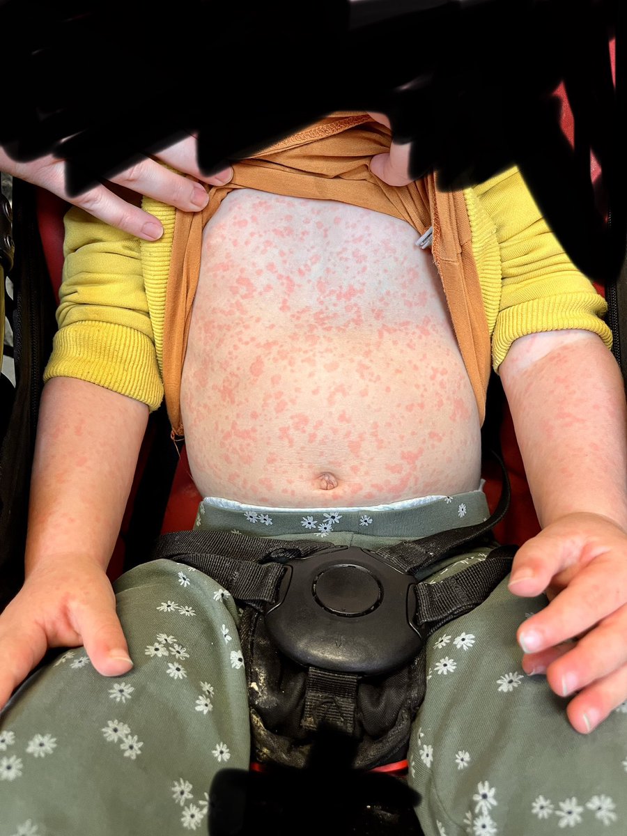 Please vaccinate #measles