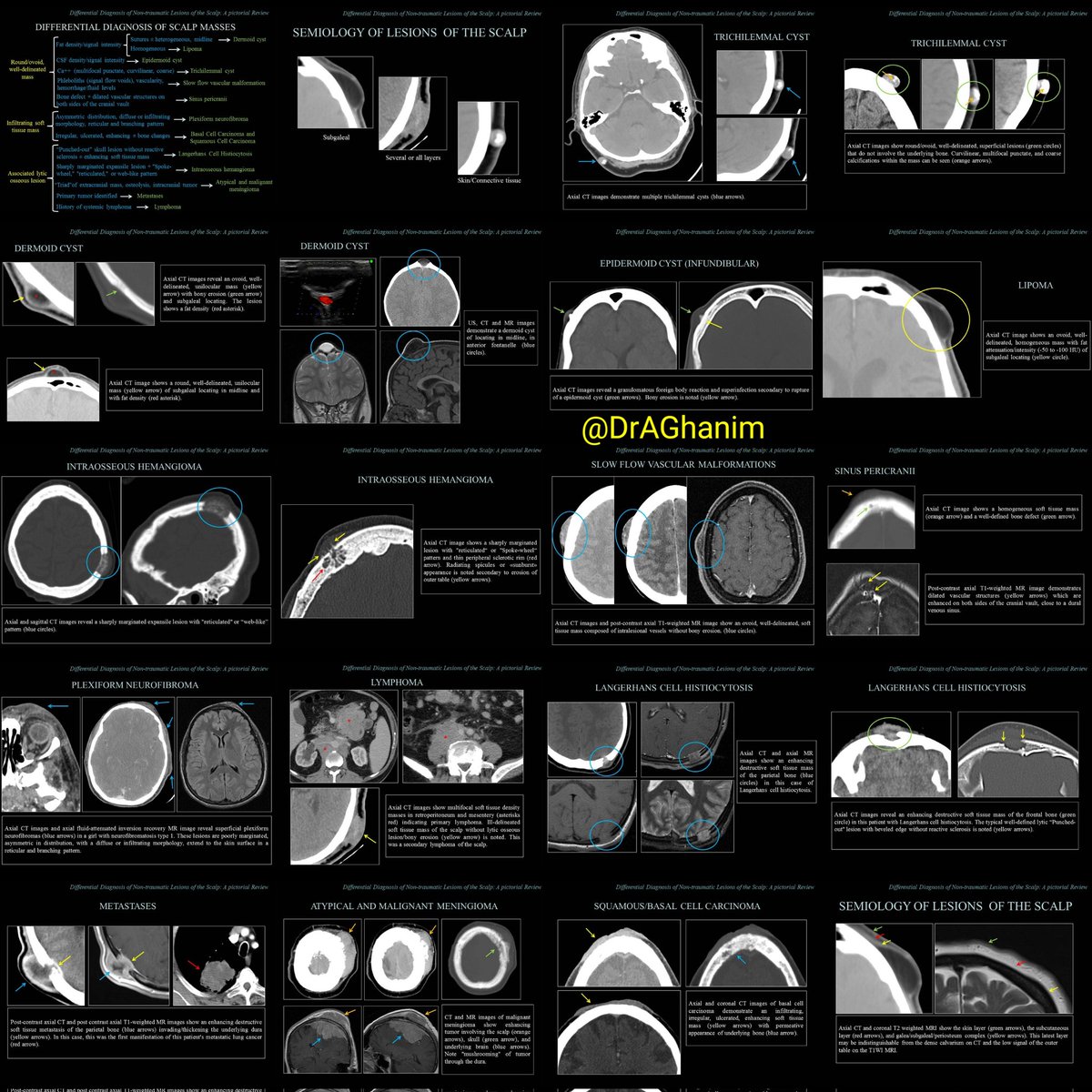 DDx   ...  CT/MRI Imaing of Scalp Mass