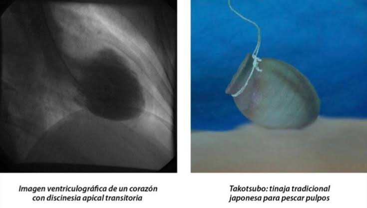 - El síndrome de #Takotsubo es un fascinante trastorno del corazón 💔:

  - Se #caracteriza por dolor torácico y anomalías en el movimiento de la pared ventricular izquierda, que se extienden más allá del territorio de una sola arteria coronaria.

- 🧬 Se cree que es una…