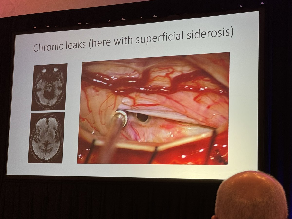 #SOAPAM2024 “No guidelines for surgical approach to #PDPH with persistent CSF leak” @WouterSchievink ✅ persistent symptoms (sometimes with normal imaging) ✅ ventral leaks (thru & thru dural punctures) ✅ cortical vein/dural sinus thrombosis ✅ chronic leaks