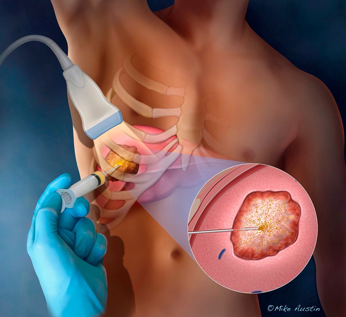 Cover illustration by Mike Austin depicting a substance that's injected into a liver tumor for tumor ablation. Explore more by Mike: buff.ly/3ngt8n8 #tumor #ablation #oncology #thoracicsurgery #coverillustration #medical #illustration #medicalillustration #sciart #3D