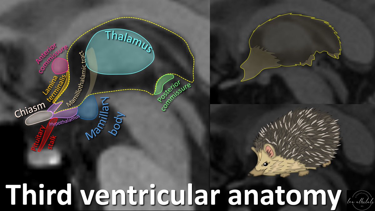 They say three’s a crowd!

Anatomy at the 3rd ventricle is crowded by important structures!

How can YOU remember anatomy in this region?

3rd ventricle looks like a hedgehog.

And that hedgehog can keep you from hedging about anatomy here! Here's how it can help you remember:
