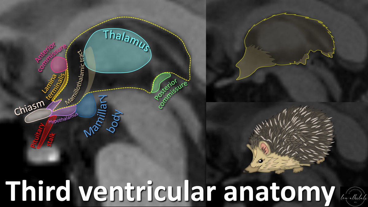 They say three’s a crowd! Anatomy at the 3rd ventricle is crowded by important structures! How can YOU remember anatomy in this region? 3rd ventricle looks like a hedgehog. And that hedgehog can keep you from hedging about anatomy here! Here's how it can help you remember:…