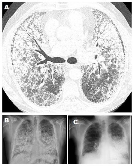 @hemo_shk @IhabFathiSulima Pulmonary Alveolar Microlithiasis • A rare, chronic lung disease with bilateral intra-alveolar calcium and phosphate deposition throughout the lung parenchyma with predominance to lower and midzone. • Associated with mutation in SLC34A2 gene that encodes a sodium-phosphate…