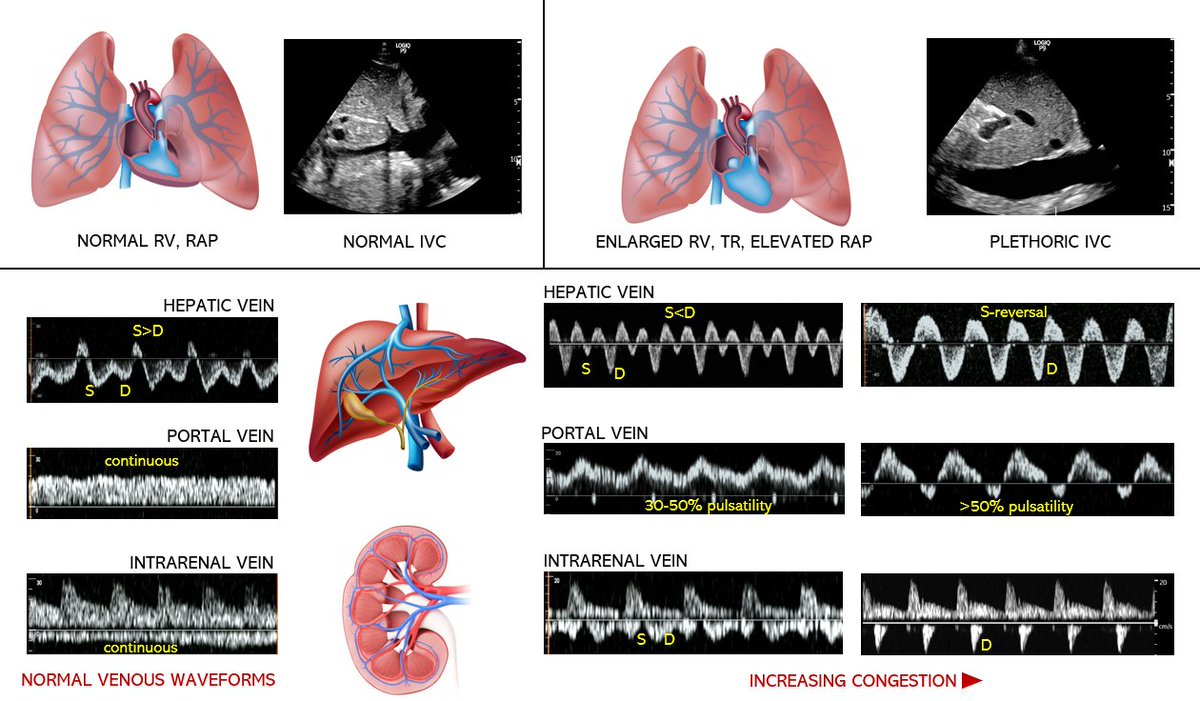 RV failure and venous congestion.
#VExUS #POCUS #Nephpearls 
🔗karger.com/crm/article/13…