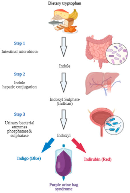 @NicoGagelmann 🔴Purple urine bag syndrome (PUBS) is rare disease entity, occurs predominantly in constipated women, chronically catheterized and associated with bacterial urinary infections that produce sulphatase/phosphatase.