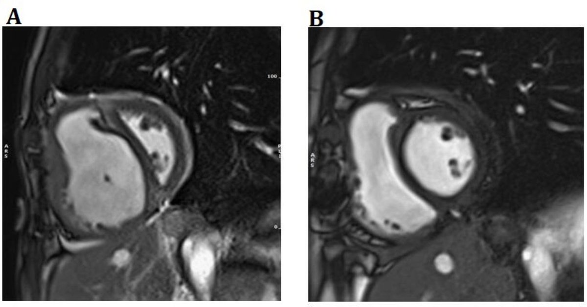 Cardiac MRI in the assessment of chronic thromboembolic pulmonary hypertension and response to treatment #WorldPHDay @JWeirMcCall thorax.bmj.com/content/79/1/90