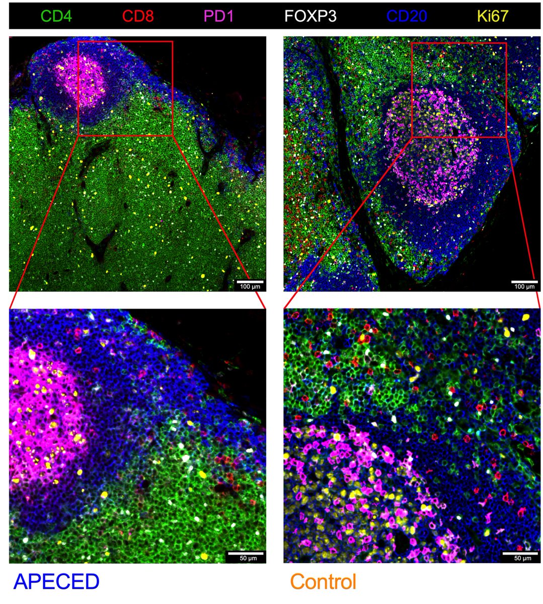 IivoHetemaki's tweet image. The final manuscript of my PhD thesis is now available in @jacionline!
We studied an #inbornerrorofimmunity #APECED and found dysregulated germinal center reaction with expanded follicular T helper cells to underlie B cell pathology in the disease. ⛓️1/12

pubmed.ncbi.nlm.nih.gov/38128835/