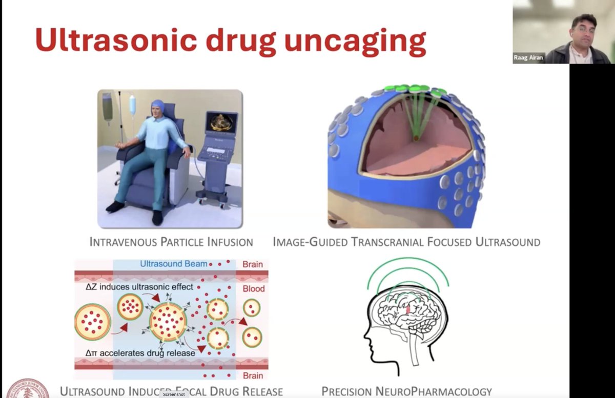 How does ultrasound 'drug uncaging' work as a delivery system for treating neurological diseases. Raag Airan @Stanford AAN Denver talk 1- give acousto-mechanically activated liposome IV, 2- hit with ultrasound, 3- drug releases, 4- precision neuropharmacology achieved.