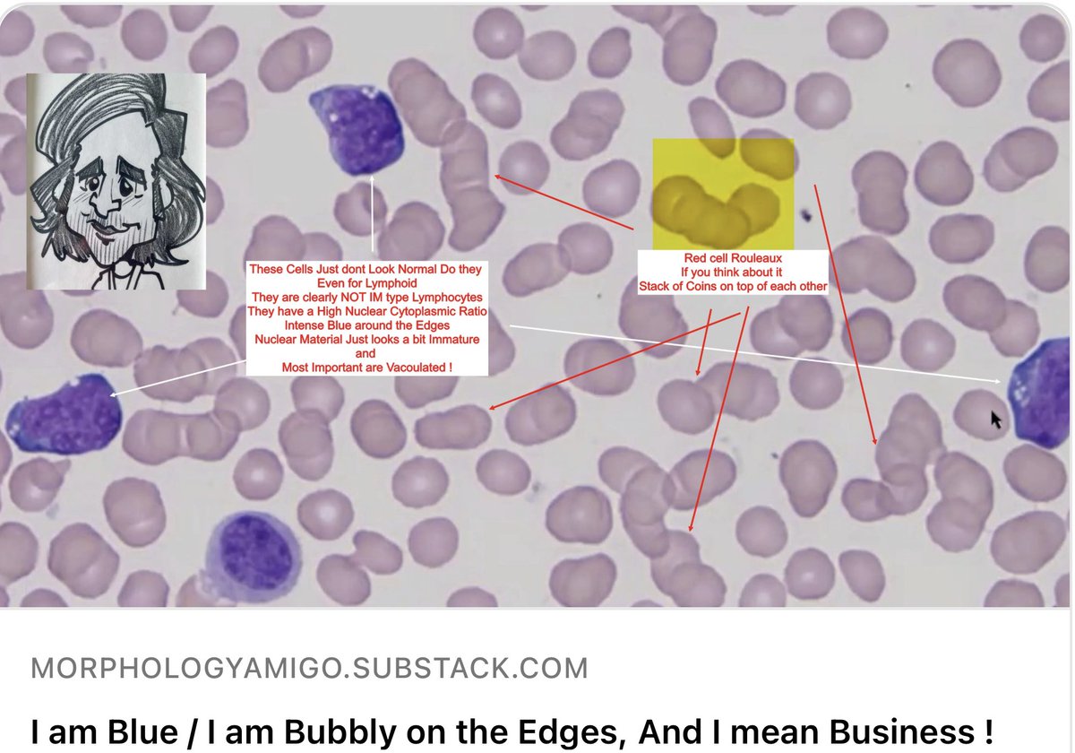 @PriyaSriRajah @nihardesai7 @BloodScientist @graham74GC detailed discussion on this tweet open.substack.com/pub/morphology… #medtwitter #hematology #medicine