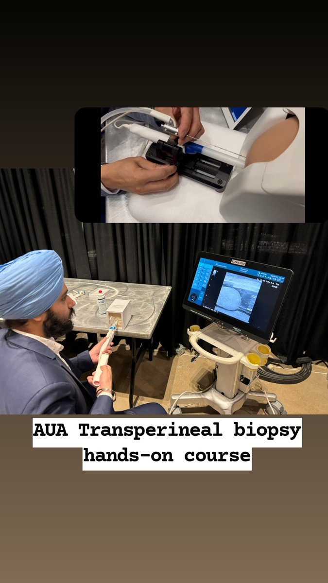 Attended a hands-on session of transperineal prostate biopsy. Got newer insights into transperineal freehand, fusion biopsy, hydrogel placement and spacer placement procedures. Hope to replicate this in my practice. #AUA24 #prostatecancer #prostate