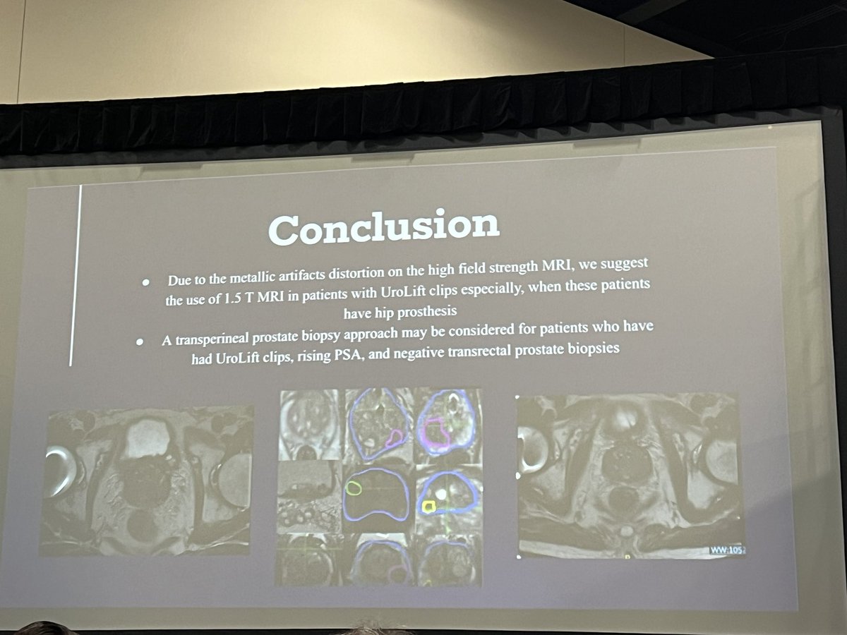 Great study by Dr. Victoria Bird on post-Urolift MRI 📍1.5 T MRI has less distortion than 3T 📍Anterior prostate has most distortion 📍Consider TP biopsy if neg TR biopsy and rising PSA #AUA24