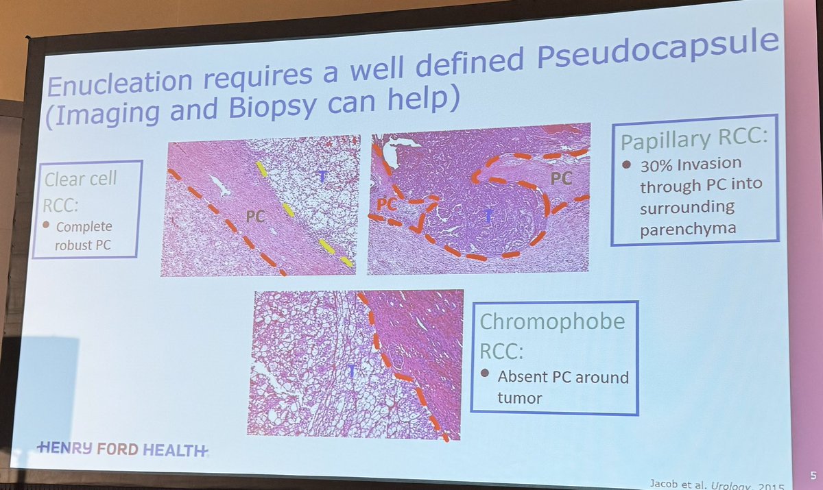 Tiago Borelli Bovo (@uroborelli) on Twitter photo Thinking about tumor enucleation in partial nephrectomy? Keep in mind that RCC has a well defined pseudocapsule among other histologies ! Unique talk by <a href="/CraigRogersMD/">Craig Rogers MD</a> at <a href="/SocietySURS/">Society of Urologic Robotic Surgeons (SURS)</a> #AUA2024 Thinking about tumor enucleation in partial nephrectomy? Keep in mind that RCC has a well defined pseudocapsule among other histologies ! Unique talk by <a href="/CraigRogersMD/">Craig Rogers MD</a> at <a href="/SocietySURS/">Society of Urologic Robotic Surgeons (SURS)</a> #AUA2024