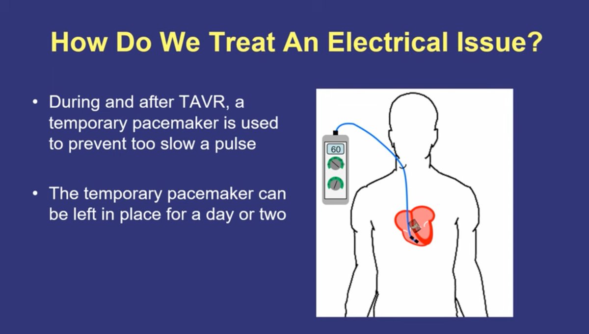 Patient education about TAVR procedure and why patients sometimes also need a pacemaker.
Take away the fear and misunderstanding.
Feel free to share this video with patients! ⬇️
Link:
youtu.be/6en9BZ5aOr0?si…