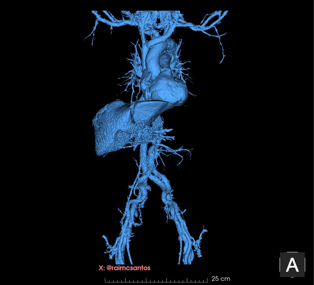 raimcsantos's tweet photo. 79yo, m, #celiac trunk #ectasia, #brachiocephalic trunk looping and left #vertebral #artery looping. The #iliac arteries with fantastic tortuosity so as not to compress the iliac #veins. Beautiful venous anatomy superior #cava, #azygos and inferior cava. #AortaEd #VascularEd https://t.co/DiCtedq03O