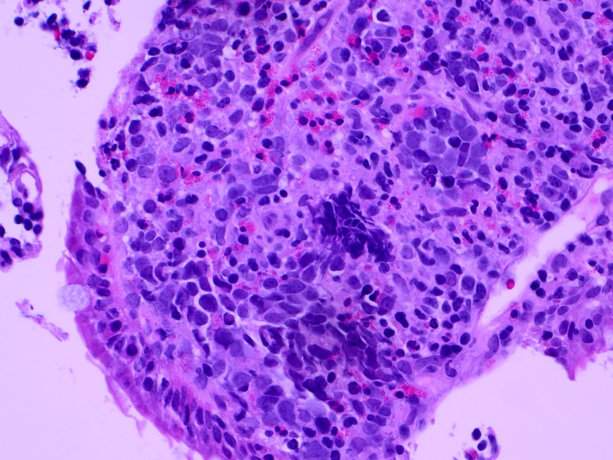 #GIpath #Surgpath #Pathresidents 68 Year old man, duodenal biopsy to rule out celiac. What do ya think? Some discussion in reply. (Colleague’s case - and he nailed this diagnosis!)