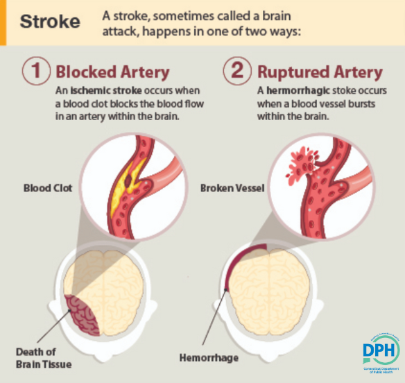 A stroke can happen 2 ways: a blocked artery or ruptured artery. In either case, parts of the brain become damaged or die. A stroke can cause lasting brain damage, long-term disability, or even death. Learn more: cdc.gov/stroke/index.h…
