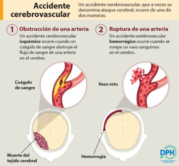 Un accidente cerebrovascular ocurre por obstrucción de una arteria o por ruptura de una arteria. En se casos, hay partes del cerebro que se dañan o mueren. Un accidente cerebrovascular puede provocar daño cerebral duradero, discapacidad a largo plazo, o incluso, la muerte.
