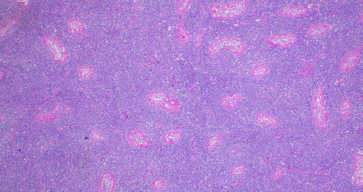 SibaElHussein's tweet image. Large B-cell lymphoma involving the testicle with a germinal center-like phenotype (CD10+BCL6+MUM1-): May occur in &amp;lt; 10% of primary large B-cell lymphoma of the testis, however, it should raise the suspicion of disseminated systemic DLBCL #hemepath #lymsm #surgpath #Pathx #MedX