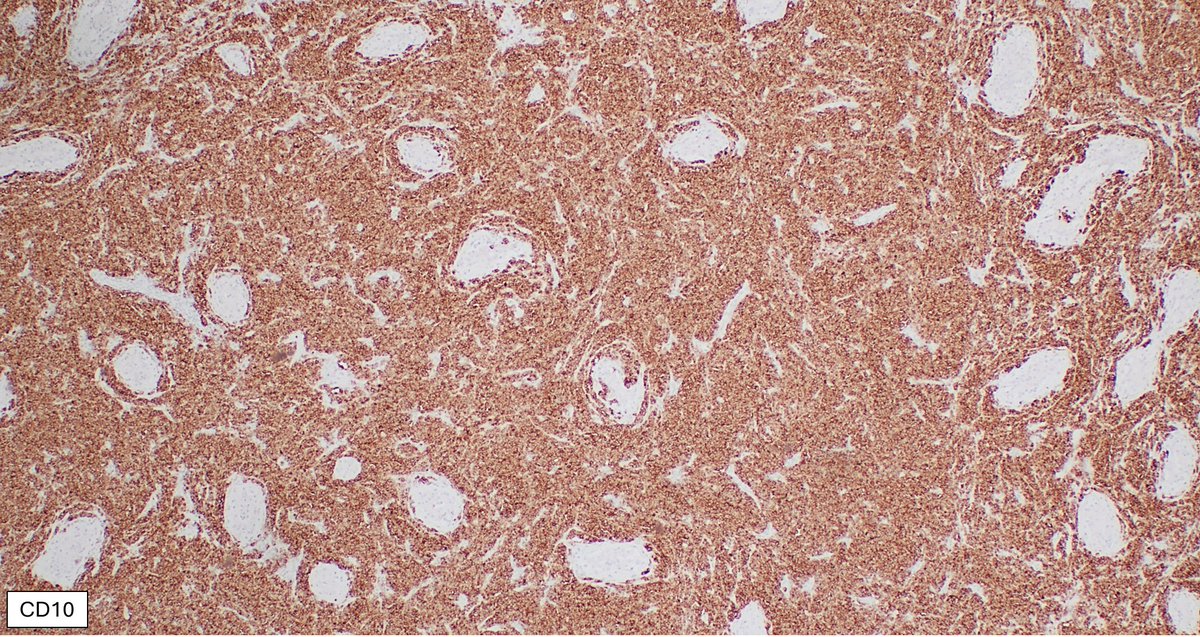 SibaElHussein's tweet image. Large B-cell lymphoma involving the testicle with a germinal center-like phenotype (CD10+BCL6+MUM1-): May occur in &amp;lt; 10% of primary large B-cell lymphoma of the testis, however, it should raise the suspicion of disseminated systemic DLBCL #hemepath #lymsm #surgpath #Pathx #MedX