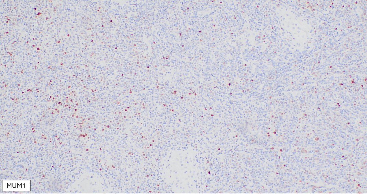 SibaElHussein's tweet image. Large B-cell lymphoma involving the testicle with a germinal center-like phenotype (CD10+BCL6+MUM1-): May occur in &amp;lt; 10% of primary large B-cell lymphoma of the testis, however, it should raise the suspicion of disseminated systemic DLBCL #hemepath #lymsm #surgpath #Pathx #MedX