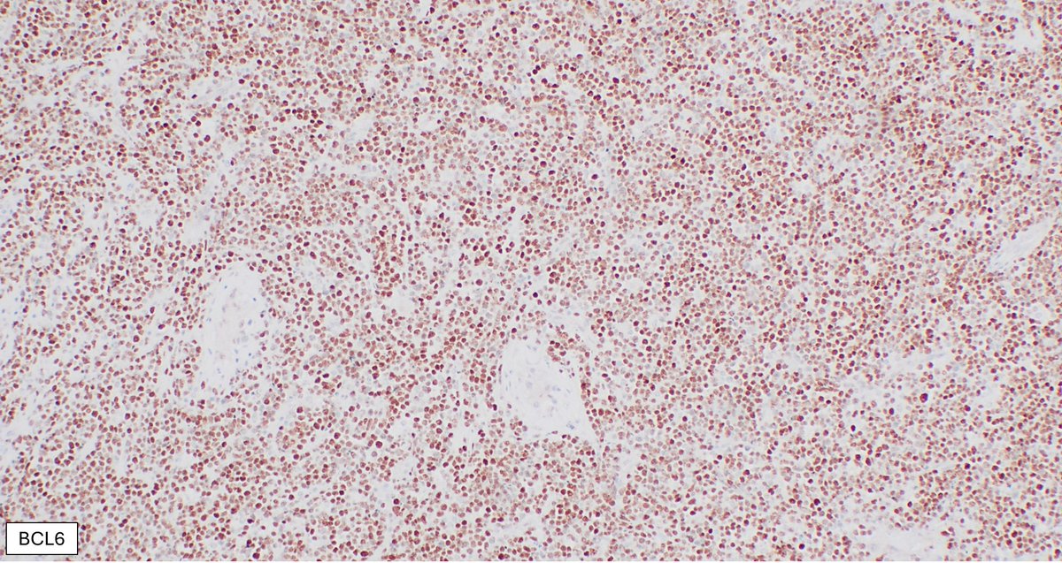 Large B-cell lymphoma involving the testicle with a germinal center-like phenotype (CD10+BCL6+MUM1-): May occur in < 10% of primary large B-cell lymphoma of the testis, however, it should raise the suspicion of disseminated systemic DLBCL #hemepath #lymsm #surgpath #Pathx #MedX