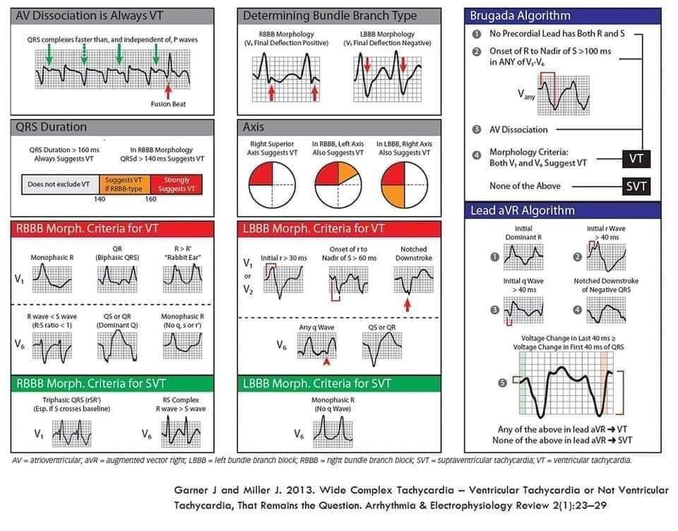 How to identify VT? ECG Quiz: youtu.be/HFw6XszLASc