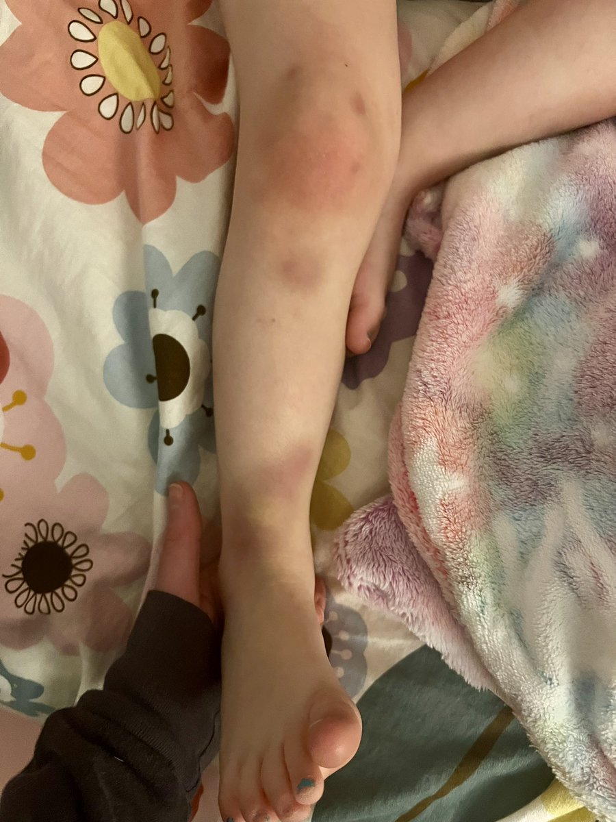 My daughter’s legs. My mom-brain coaching my pedsICU/palliative-brain “It’s not cancer. This is normal. It’s not cancer.”