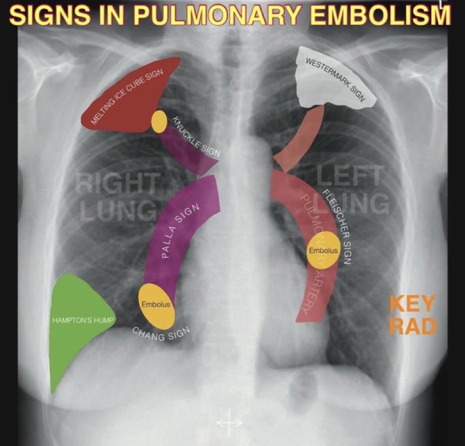 Signs of pulmonary embolism 🫁 Cr. #keyradiologist & @OGdukeneurosurg #radiology #medtwitter @Sthanu5 @IhabFathiSulima