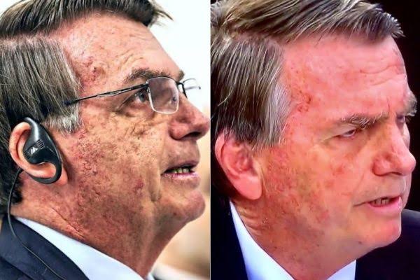 🚨 Atenção: l Bolsonaro está internado com erisipela em Manaus, sem previsão de alta. Progressão da doença pode levar a amputações ou a quadros de sepse, que oferecem risco de morte.