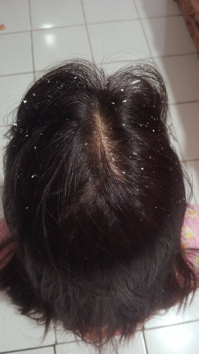 NoviaMetaR's tweet image. Pernah ga c kamu ngerasa cape banget gonta ganti shampo dari yg murah sampai yg mahal tapi rambutmu tetap ketombean parah dan bikin kamu jadi ga pede sama penampilan kamu?? Bingung ga c sama penyebabnya? Rambutku pernah dan udah byk bgt gonta ganti shampoo.

#haircare