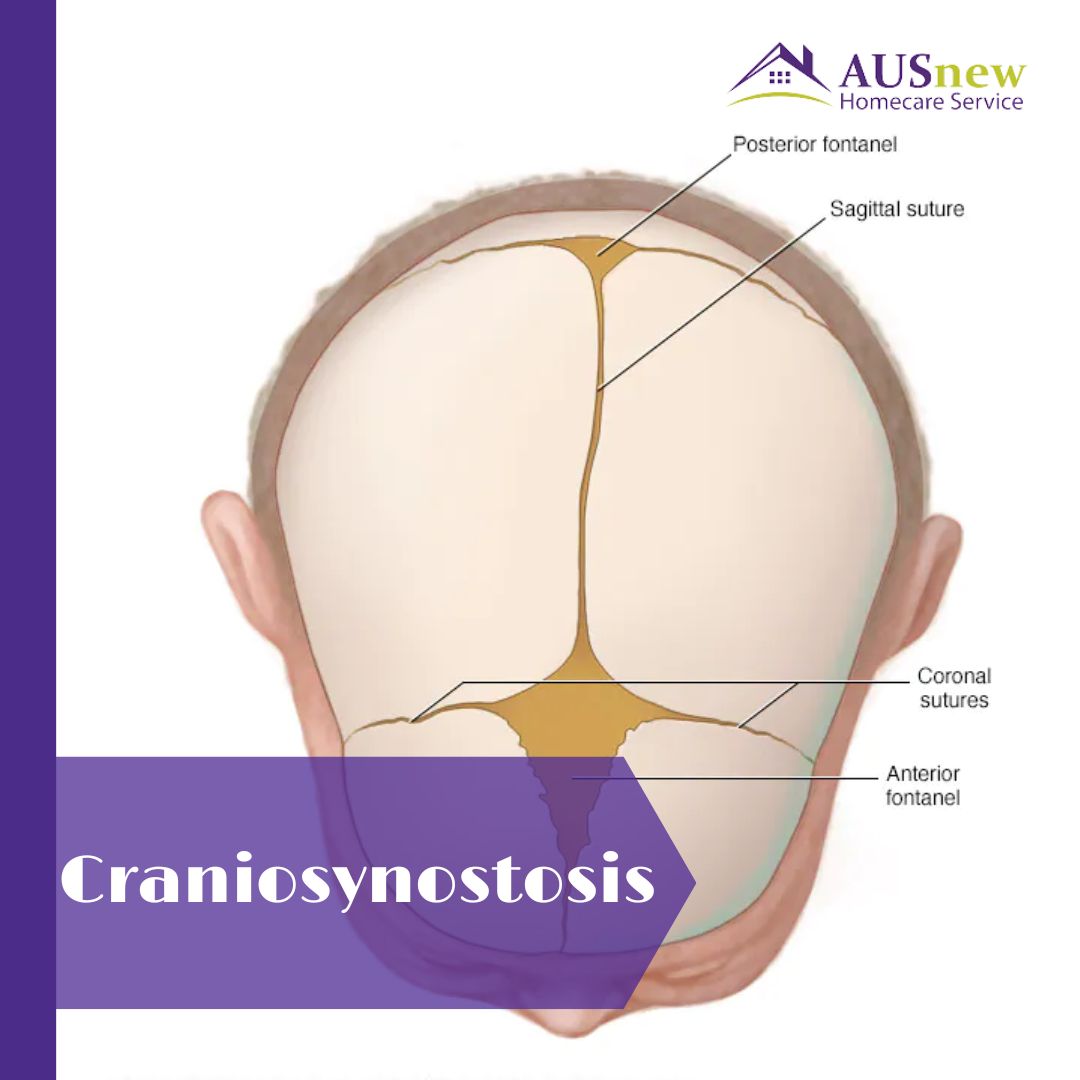 🌟Congenital condition craniosynostosis occurs when one or more fibrous joints linking the cranium's bones fuse prematurely before brain development. The cranium continues to develop, resulting in a deformed appearance. Source: Mayo Clinic #craniosynostosis #congenitaldisorder
