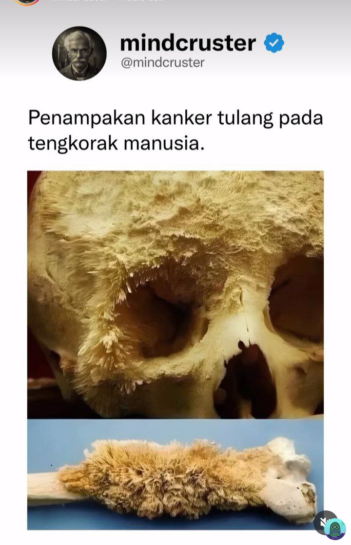 💚 masih ga ngerti kanker tuh penyebabnya apa? Dan cara cegahnya gimana?