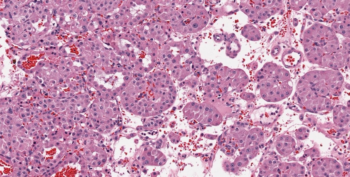 1/ Fourth #PathTweetorial of 2024. Today we're talking about pink stuff. To be exact, eosinophilic renal tumors. That's right, buckle up, it's #GUPath again! 😉 As always, there's a YT📹 bonus at the end! This time, with a twist! Image credits: Dr. Katrina Collins @katcollmd