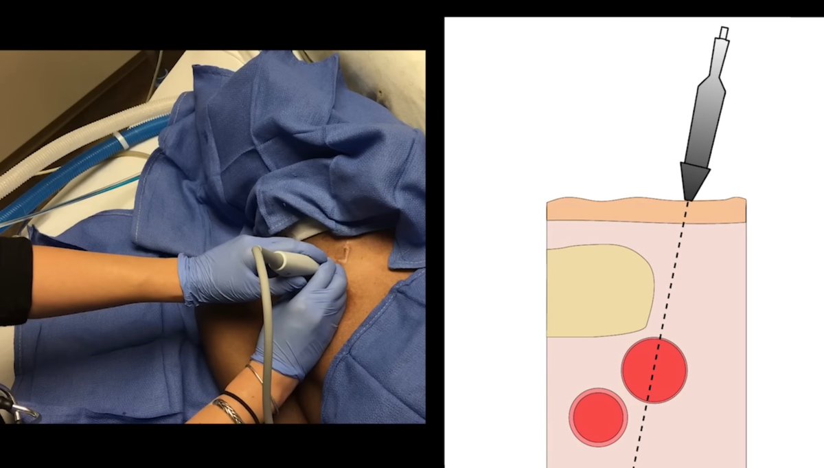 #POCUS guided subclavian venous catheter placement 🎥
🔗 youtu.be/_VYHj4sRlkc?si…
#FOAMed #FOAMcc #MedEd