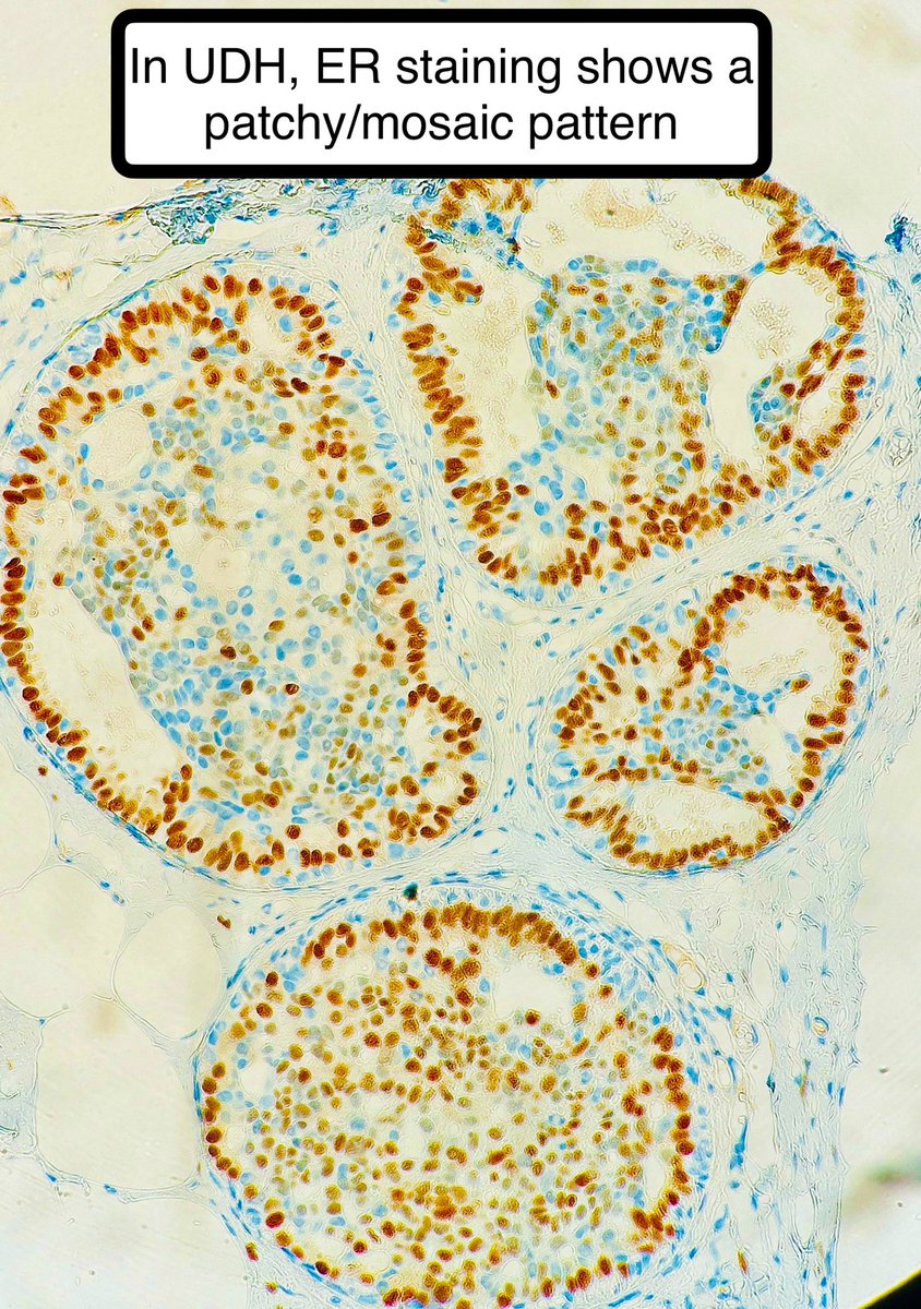 Usual Ductal Hyperplasia (UDH)

• Benign but I remember as a first year always so confused: “This looks scary. DCIS?”

• Look for architectural disarray and slit like spaces

If unsure:
• CK5/6: patchy in DUCTAL epithelium
• ER: patchy/mosaic

#pathagonia #pathx #path4people