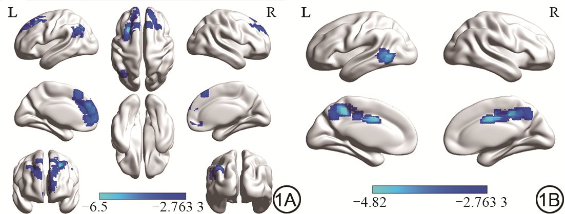 Conventional #MRI can display characteristic imaging lesions of #CSVD, while #rs-fMRI sequence can early detect reduced #DC and #FC in brain regions. The CSVD score and DC, FC are significantly correlated with clinical neuropsychological scores.
med-sci.cn/cgzcx/article/…