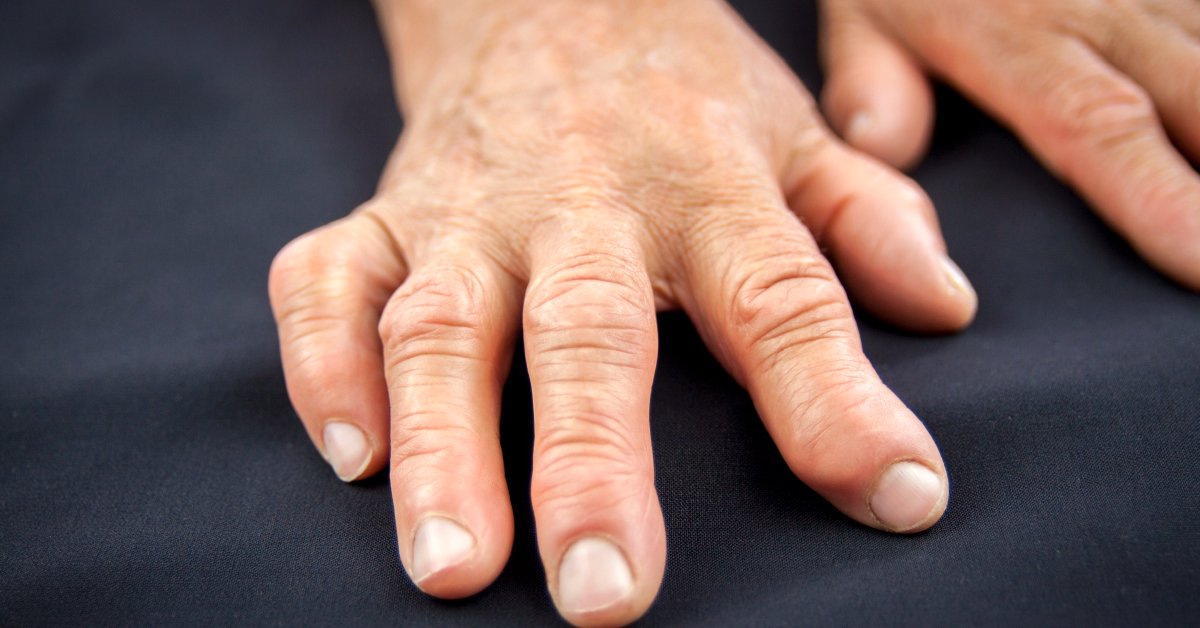 Rheumatoid arthritis is an autoimmune disorder that affects your joints and causes swelling and pain. Over time, inflammation can damage your cartilage and bones, and you can’t move them as well. wb.md/3JNfdB0