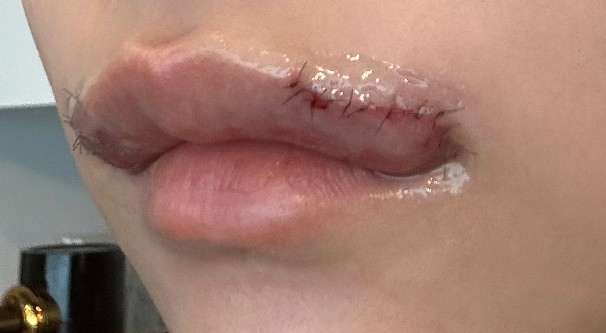 shion___0403's tweet photo. 昨日口角挙上と外側人中してめっちゃ腫れてるけど
縫い目綺麗じゃないでしょうか？❀.(*´▽`*)❀.
この仕上がりで日本で形成外科医で今はもうやってないと思うけど当時のキャンペーンでモニター無し88,000円だった⭐️
モニターありだと44,000円だった破格🥨
ケチんぼ整形万歳🥨 https://t.co/t5n7ppVC4t