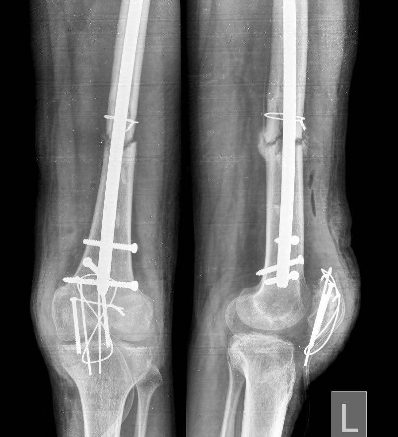 18 M; 6 M old Elsewhere primarily operated femur and patella injury.
Came after 2 month post op with knee pain and difficulty in walking.
Nail dynamization and Bone marrow inj + medial AP lock screw distally and replacement of IL bolt done.
#Trauma #surgery #orthotwitter #Ortho