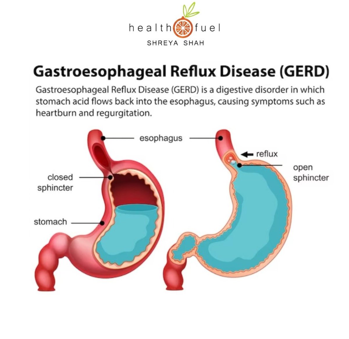 Gastro esophageal Reflux GERD Do U Have Burning Sensation In Ur Chest gastro-esophageal-reflux-gerd-do-u-have-burning-sensation-in-ur-chest