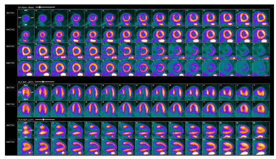 MyASNC's tweet image. New #CVNuc #ThinkPET case: 71-yr male, prior smoker, HLD, preop eval for AAA repair -&amp;gt; chest pain; cath reveals LAD CTO. What does subsequent PET show? Vote below. 
@JNCjournal @CardioNerds @BCIS_uk @PETpartnership