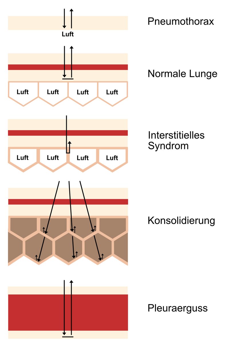 Nützliches Wissen zum Thema Lungen #POCUS Luftanteil in Lunge/Pleura: Pneumothorax - 100% Normale Lunge - 98% Interstitielles Syndrom - 95% Konsolidierung - 5-10% Pleuraerguss - 0%