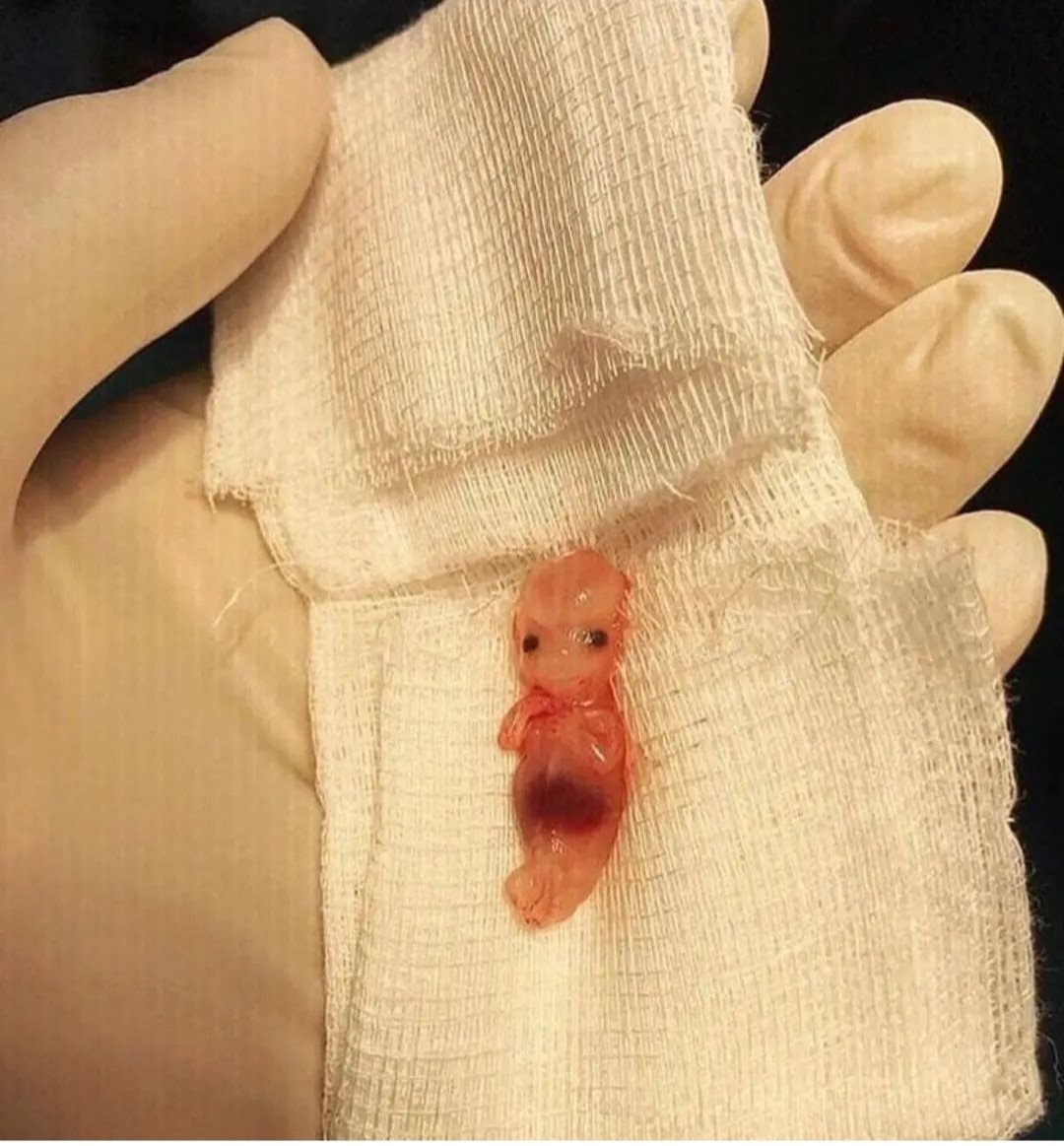 This is the extraction of a 9-week-old fetus from an ectopic pregnancy. It is indeed a unique opportunity to observe the full body of the fetus without any damage.