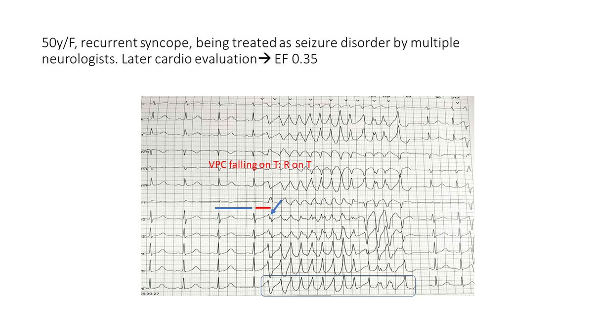 Why ECG/Holter is mandatory in all patients with recurrent seizures?