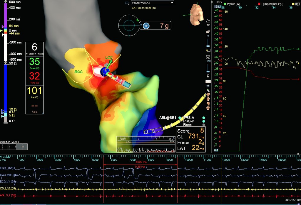 Kevin Brady (@hapa_ep) on Twitter photo What is it about the R-L interleaflet triangle (ILT) between the right and left coronary cusps that causes it to be the site of successful ablation for so many LV summit PVCs? <a href="/Maeskander/">Mike Eskander</a> <a href="/DrRoderickTung/">Roderick Tung</a> <a href="/DrFerminGarcia/">Fermin Carlos Garcia</a> <a href="/javadm20/">javad mikaeili</a> <a href="/narrowQRS/">JMC</a> <a href="/B_Naz_MD/">Babak Nazer</a> <a href="/MBarakatMD/">Michel Barakat</a> #EPeeps #ablateVT What is it about the R-L interleaflet triangle (ILT) between the right and left coronary cusps that causes it to be the site of successful ablation for so many LV summit PVCs? <a href="/Maeskander/">Mike Eskander</a> <a href="/DrRoderickTung/">Roderick Tung</a> <a href="/DrFerminGarcia/">Fermin Carlos Garcia</a> <a href="/javadm20/">javad mikaeili</a> <a href="/narrowQRS/">JMC</a> <a href="/B_Naz_MD/">Babak Nazer</a> <a href="/MBarakatMD/">Michel Barakat</a> #EPeeps #ablateVT