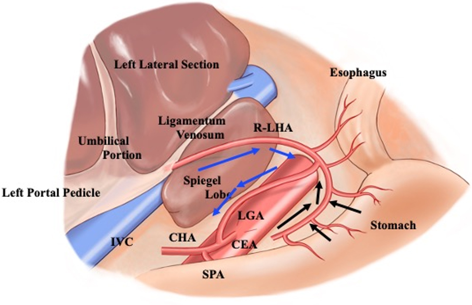 🙌 🙌 Opinion: Lymphatic spread from left-sided #intrahepatic #cholangiocarcinoma: reconsiderations based on the lymphatic drainage from the liver #MedEd 

🌱 Download:
f.oaes.cc/xmlpdf/1b606b5…