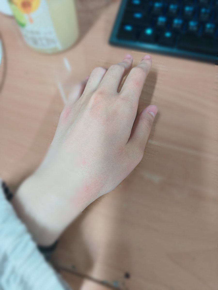 昨天下午接近四點揪朋友出來拍照w
當然！不是拍我XDD 
我是當拍人的那個www

結果拍到傍晚的時候被蚊子逼瘋🫠
手背可以一次站超過四隻的蚊子
我們學校的蚊子也太凶了ㄅ🥲🥲
圖二是其中一隻手的慘樣ww
最後拍到晚上快7點就解散了
本來想拍更晚...但是蚊子啊啊啊！！

解散回去後看檔案居然有超過400張
我整個超問號wwww
完全不曉得自己按了啥照片XDD 
怎麼會那麼多啦www
但最後自己喜歡的沒有很多🤣🤣