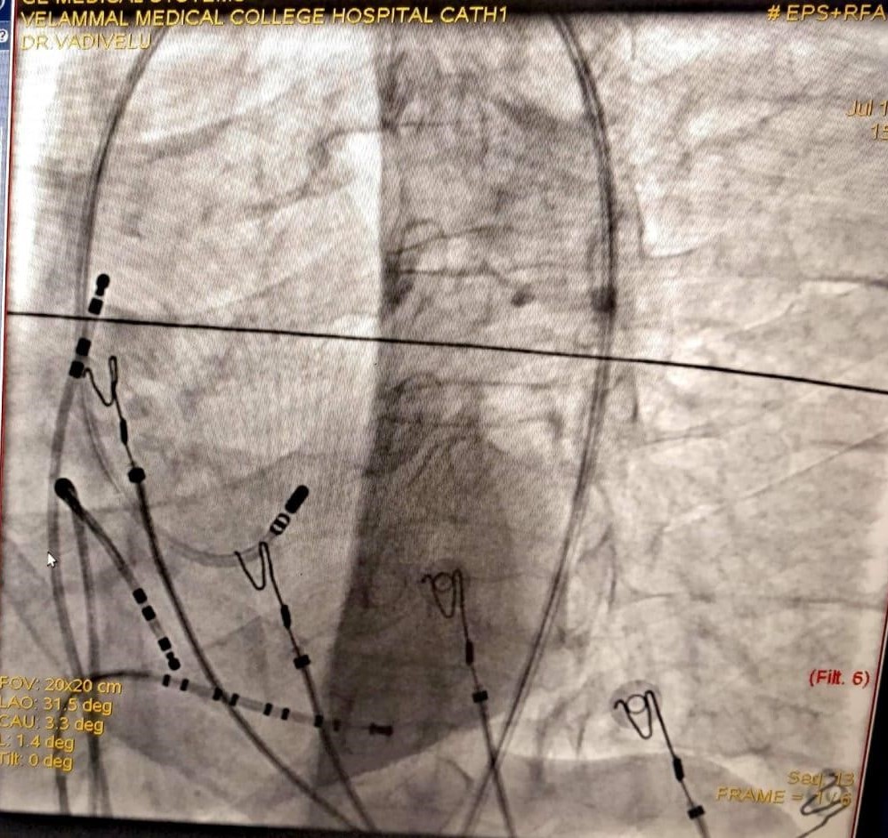 Old AWMI/Post CABG(1998) -Incessant VT; EF 0.20; Dual Tachy (VT and AF; See CS signals)
Scar VT ablation:  5 yrs and 9 months post-ablation doing well; EF 0.3